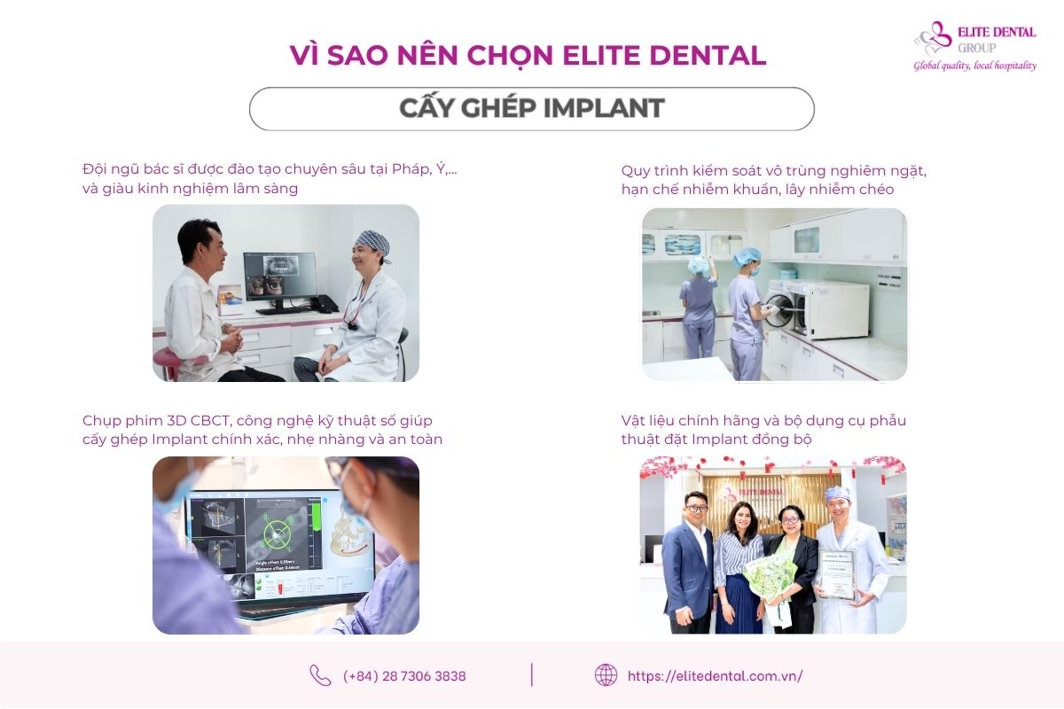 vì sao nên chọn elite dental trồng răng hàm bị sâu