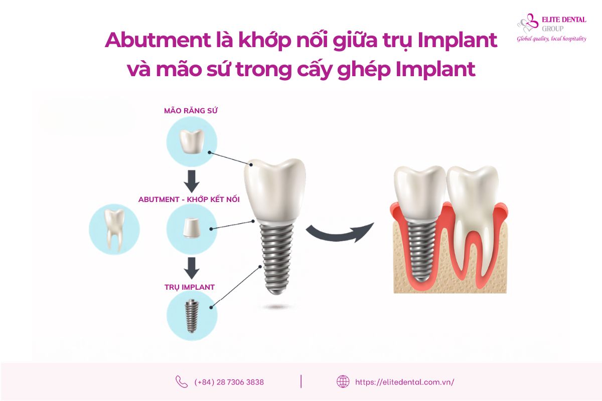 implant abutment là gì