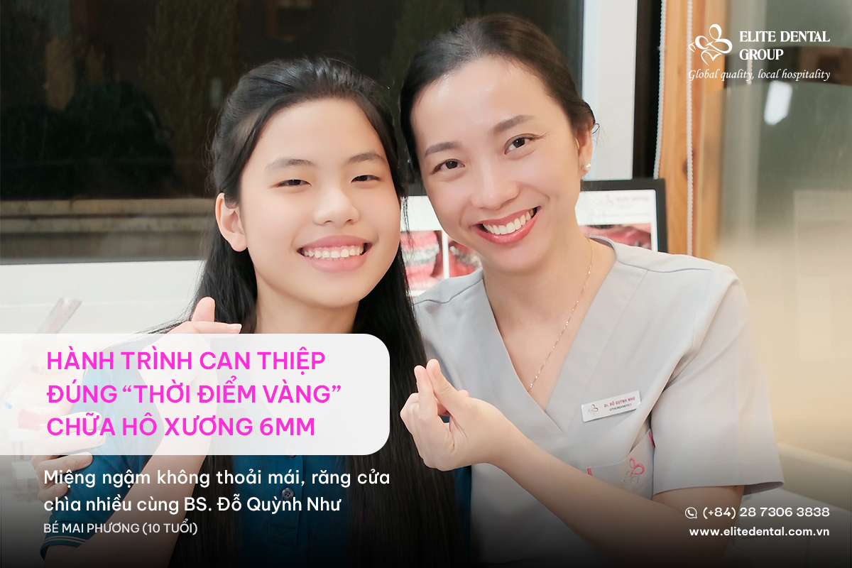 bé mai phương khách hàng niềng răng trẻ em giảm hô elite dental