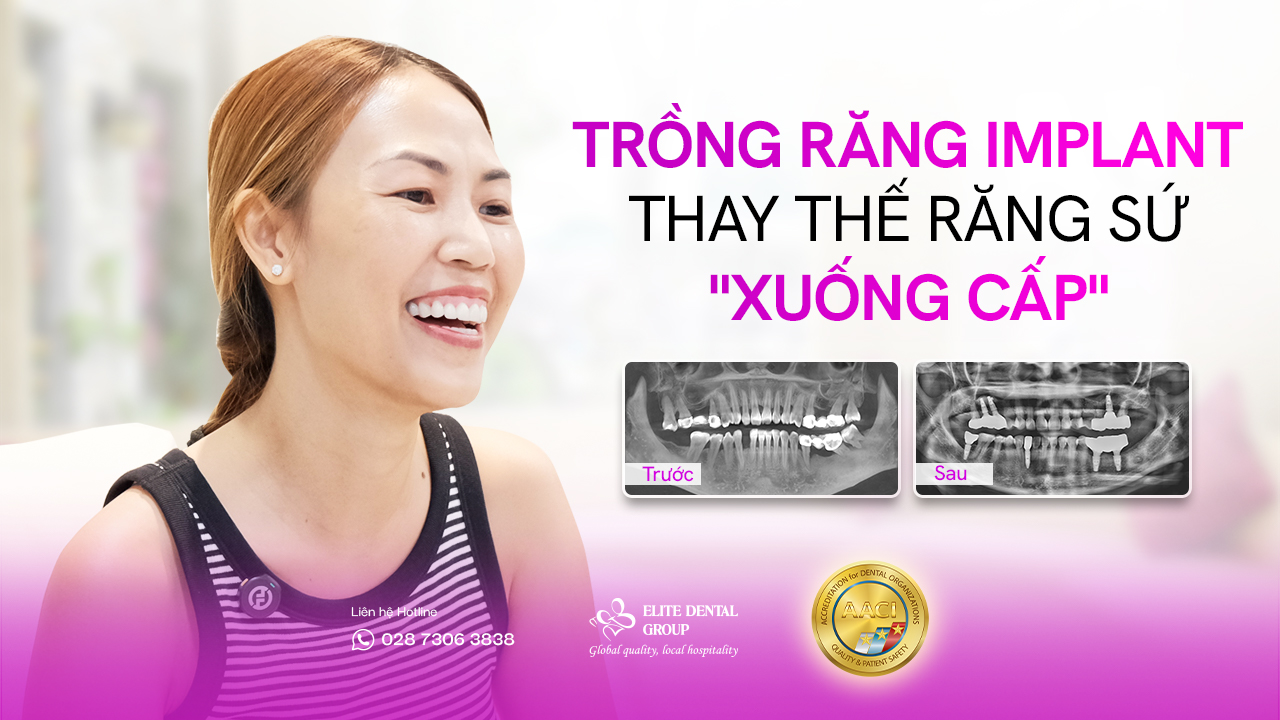 chị bội trân khách hàng trồng răng implant tại elite dental