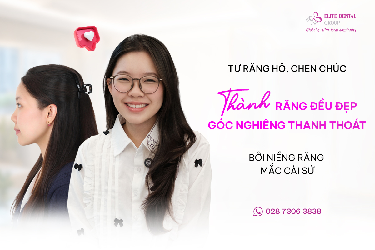 khách hàng mỹ phương niềng răng mắc cài sứ