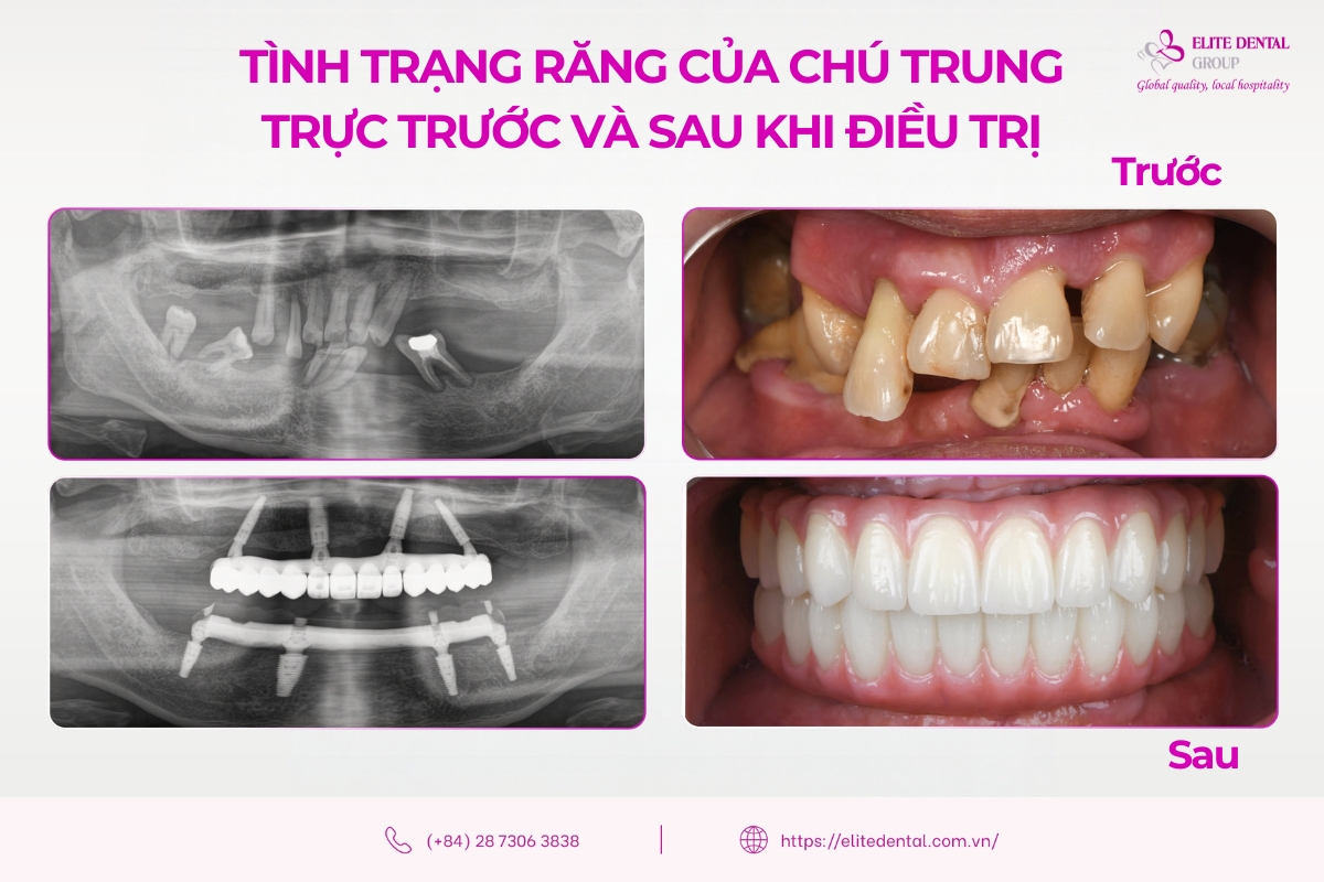 hình ảnh khách hàng trung trực việt kiều bỉ trước và sau khi cấy ghép implant toàn hàm