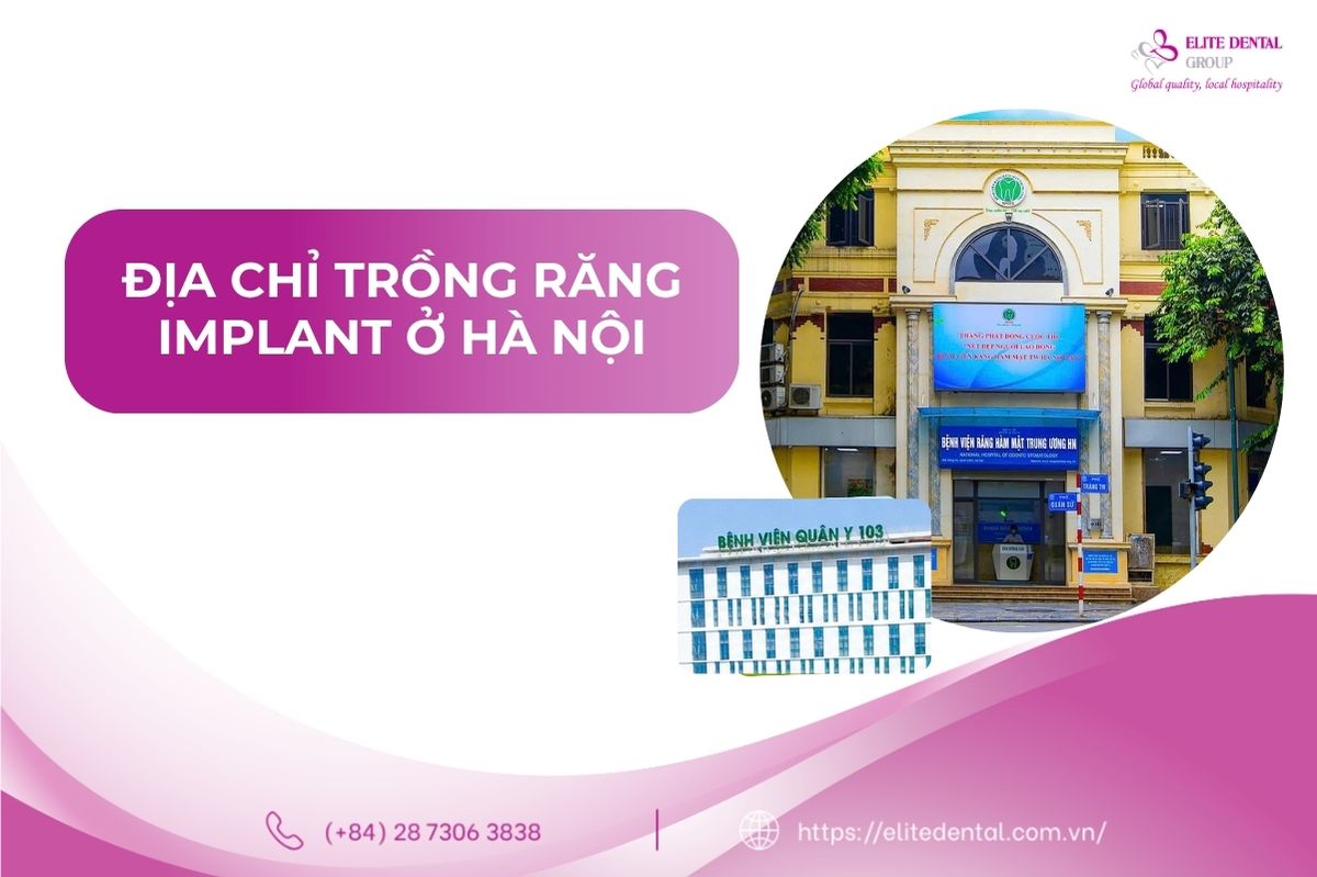 địa chỉ trồng răng uy tín ở hà nội