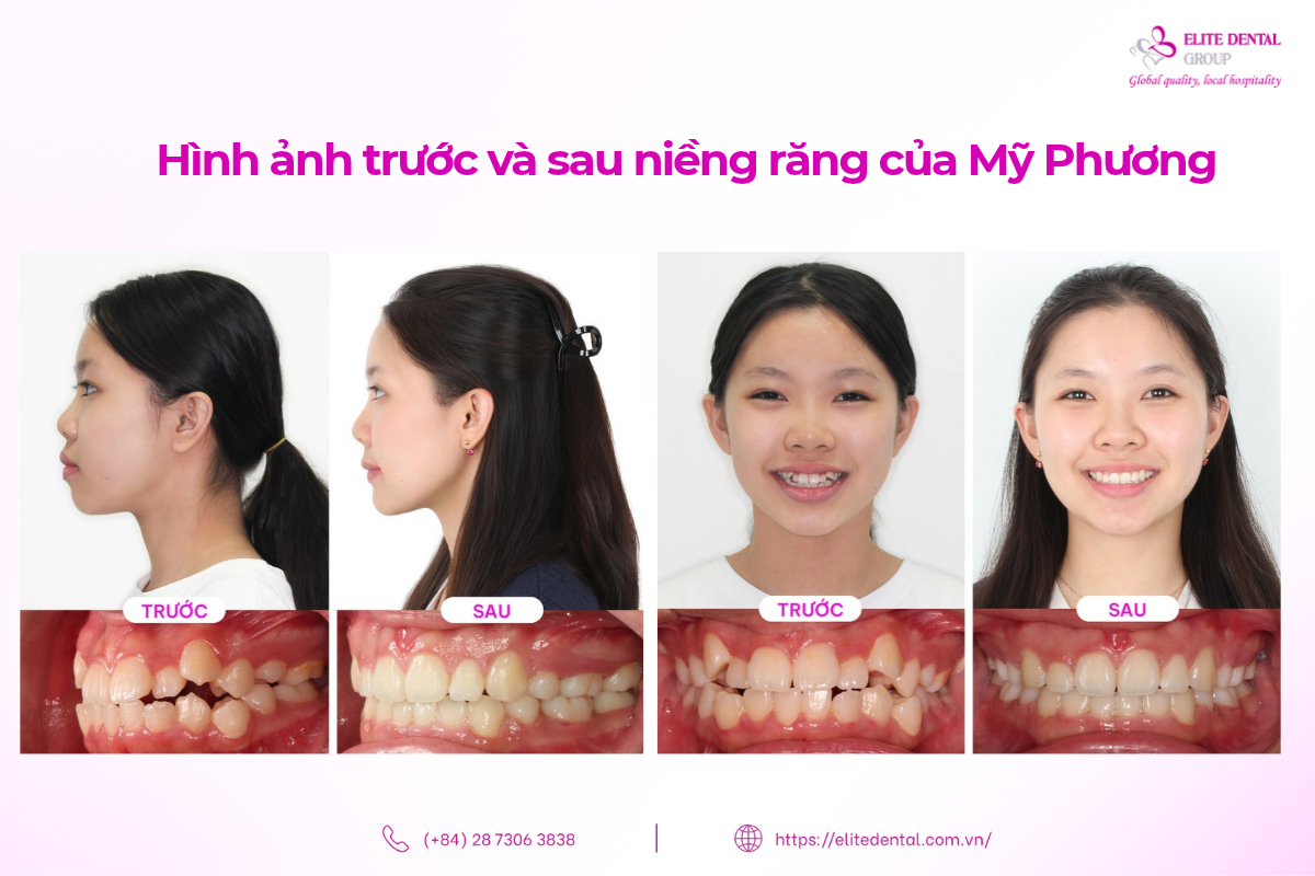 hình ảnh trước và sau niềng răng của mỹ phương